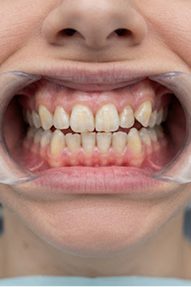 Before Dental Implant